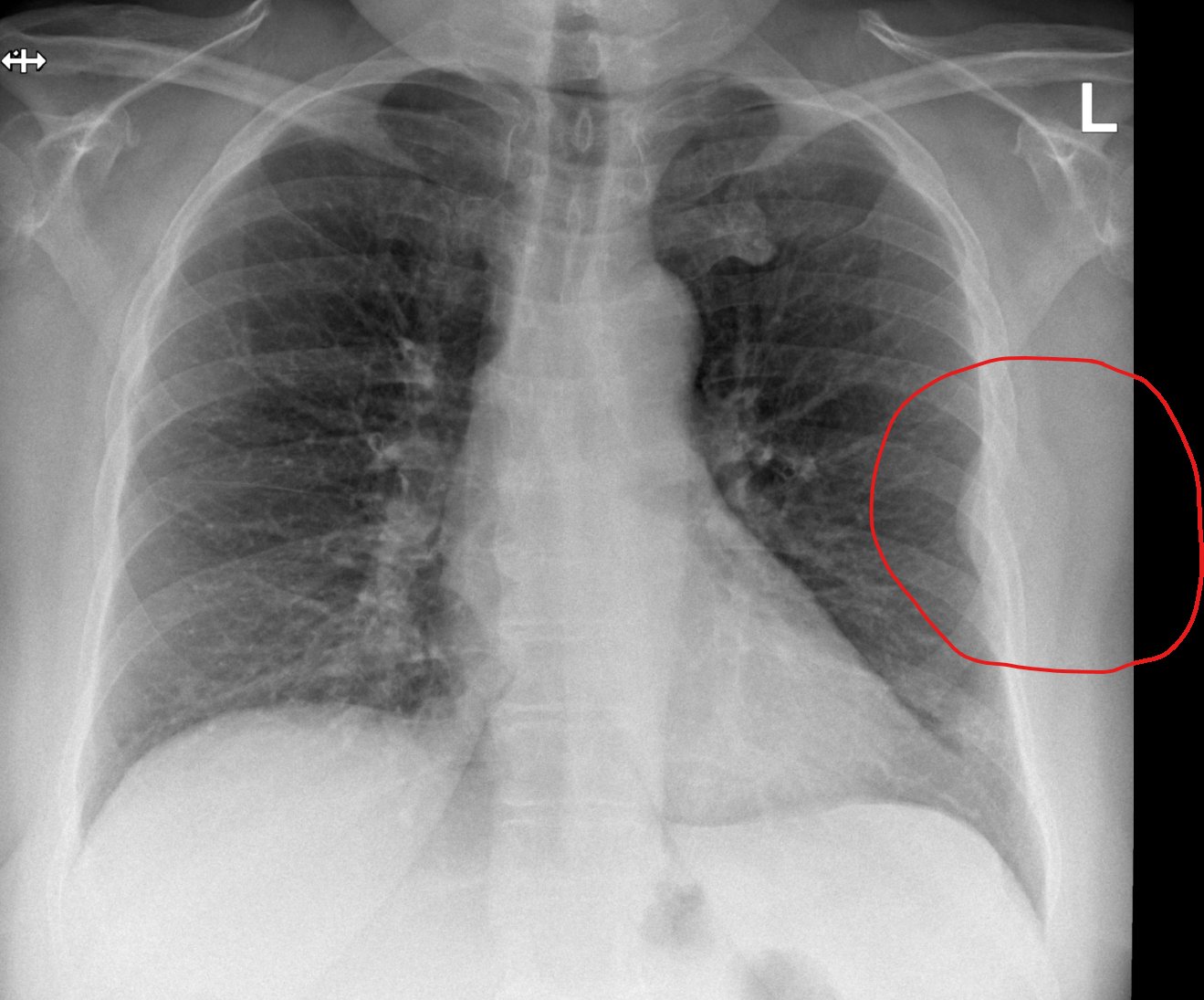 Chest X-ray from September 2023 with the tumour that was not seen, circled in red